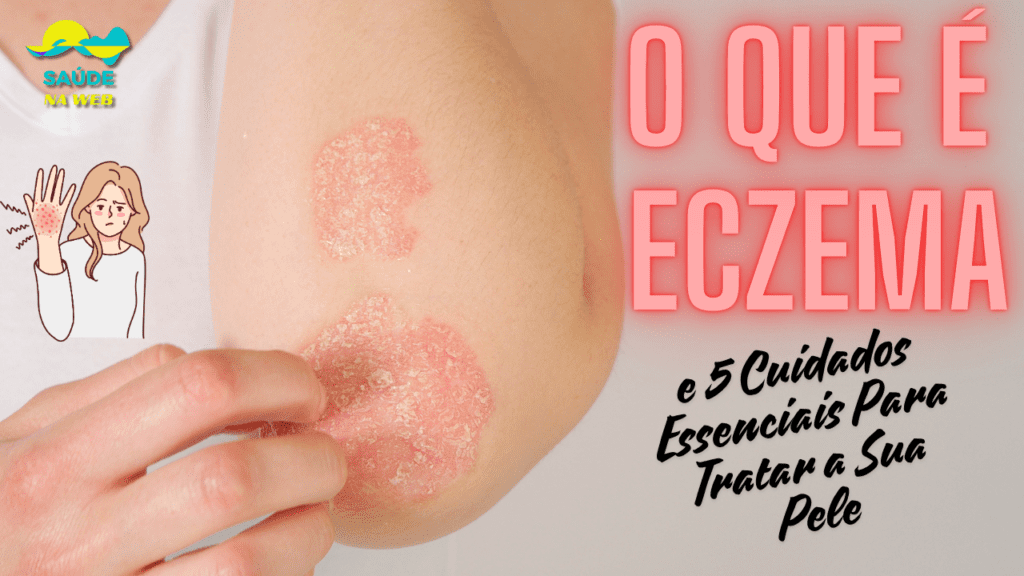 O Que É Eczema? 5 Cuidados Essenciais Para Tratar Sua Pele